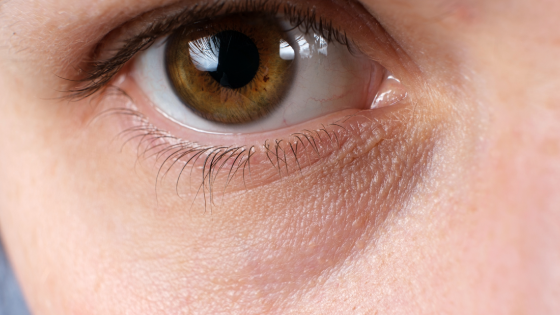 Панночки та «тіні минулого»: як боротися з темними колами під очима у молодому віці